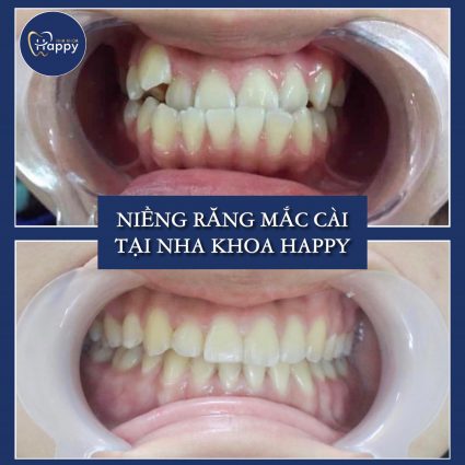 chỉnh nha uy tín thủ đức