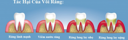 cạo vôi răng quận 9