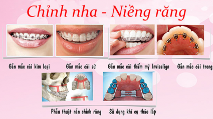 chỉnh nha