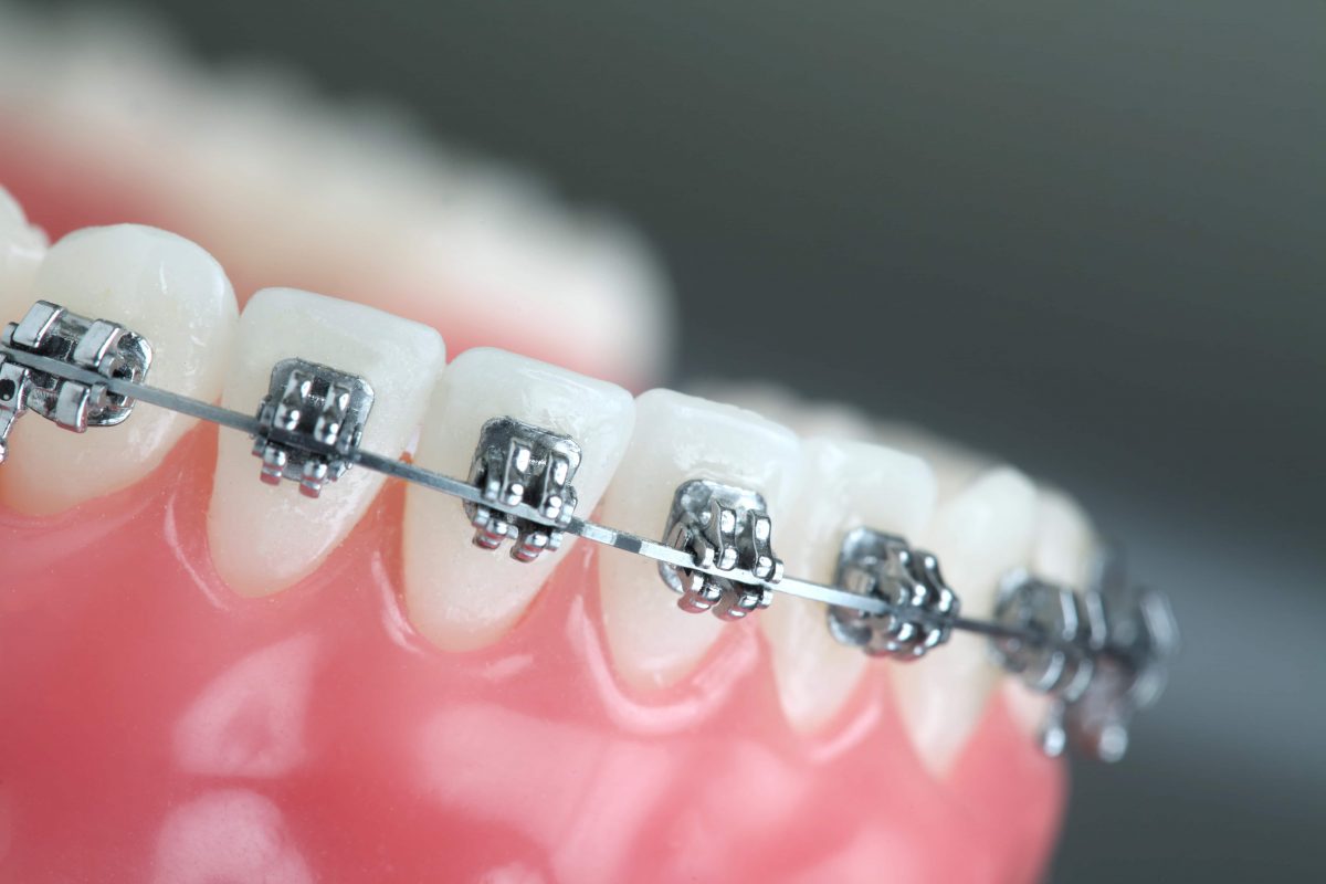 Braces image 1