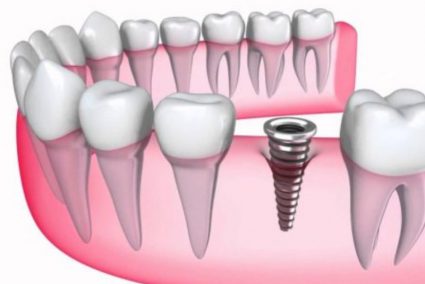 Đặt Implant vào xương hàm