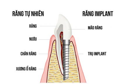 Ưu điểm của giải pháp cấy ghép Implant tại Nha khoa Happy