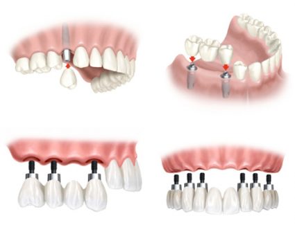 Làm răng giả gắn trên Implant