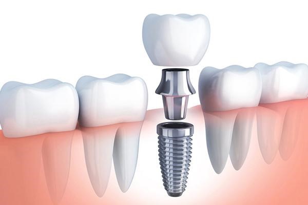 Dịch Vụ Implant - Chính Sách Bảo Hành 2022