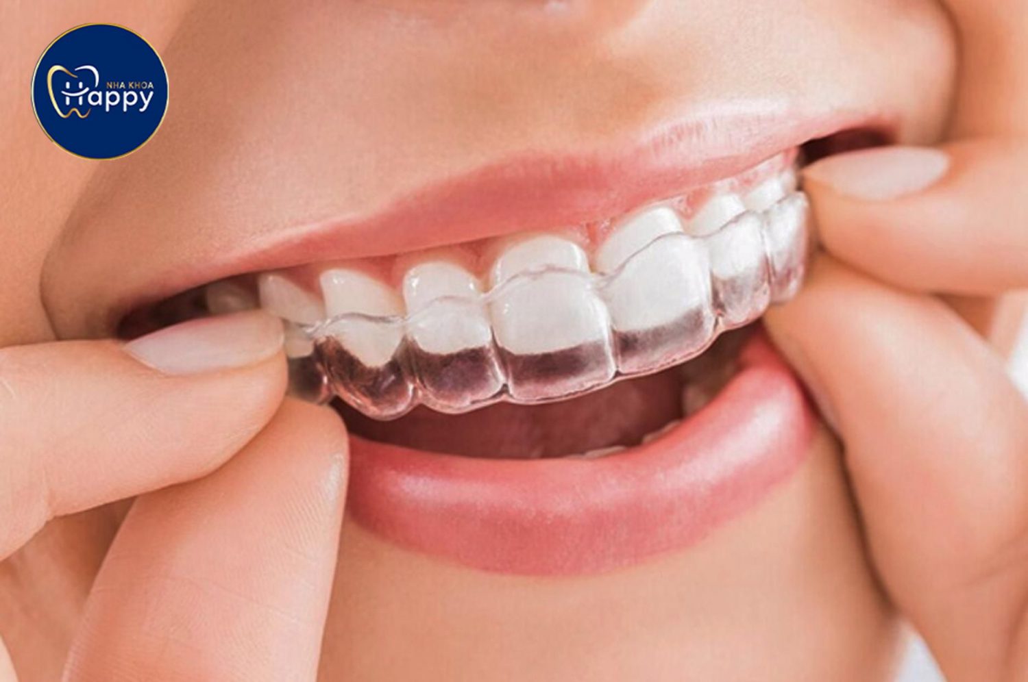 Niềng răng khay trong suốt Invisalign là gì?