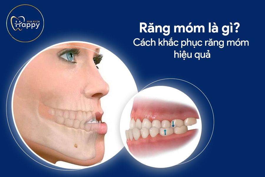 Răng móm là gì? Cách khắc phục răng móm hiệu quả