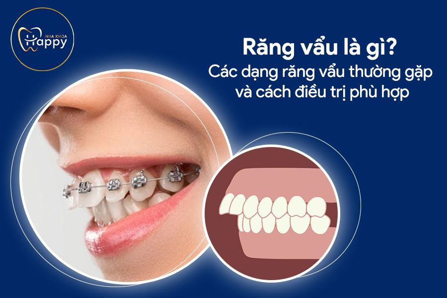 Răng vẩu là gì? Các dạng răng vẩu thường gặp và cách điều trị phù hợp