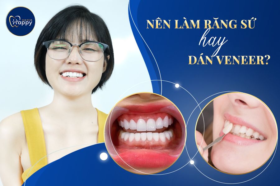 Nên bọc răng sứ hay dán Veneer? So sánh điểm giống và khác nhau