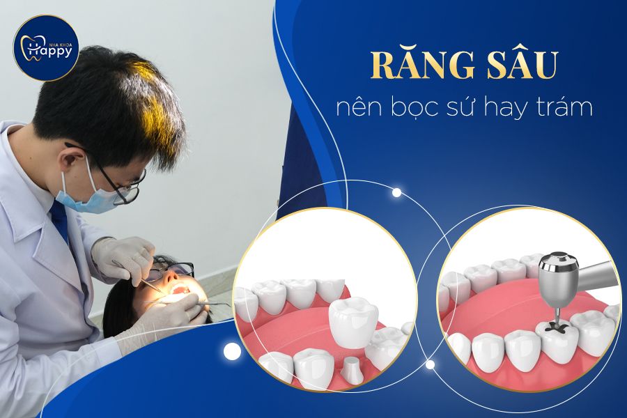 Răng sâu nên bọc sứ hay trám – Phương pháp nào tối ưu nhất?