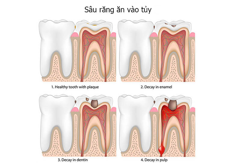 SÂU RĂNG VÀO TỦY PHẢI LÀM SAO? CÁC BIỂU HIỆN VÀ CÁCH ĐIỀU TRỊ