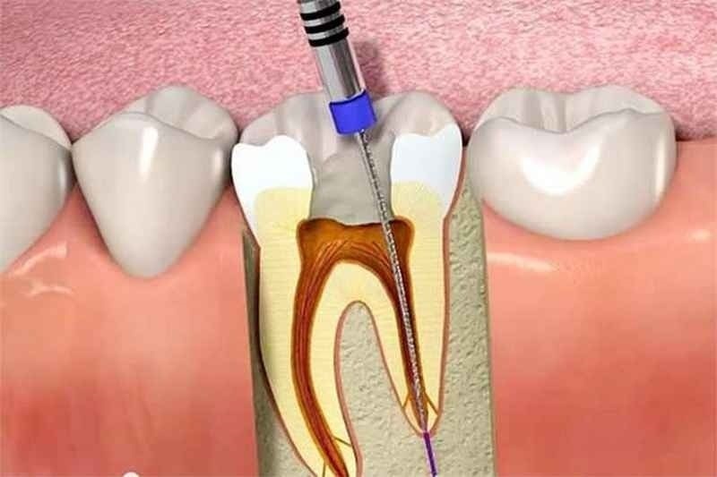 SÂU RĂNG VÀO TỦY PHẢI LÀM SAO? CÁC BIỂU HIỆN VÀ CÁCH ĐIỀU TRỊ