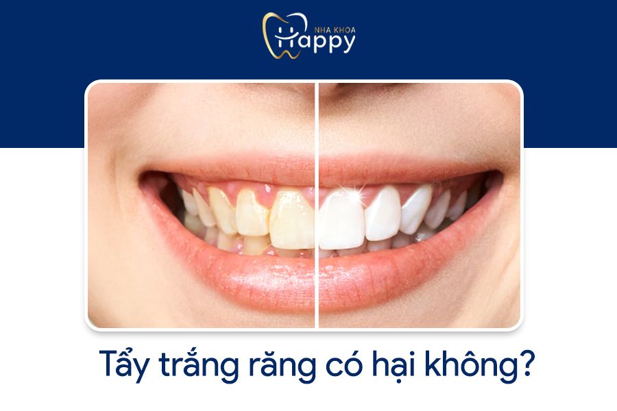 TẨY TRẮNG RĂNG CÓ HẠI KHÔNG? NHỮNG LƯU Ý KHI TẨY TRẮNG RĂNG