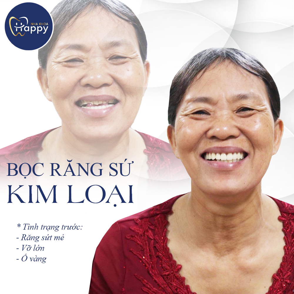 KH BỌC RĂNG SỨ KIM LOẠI