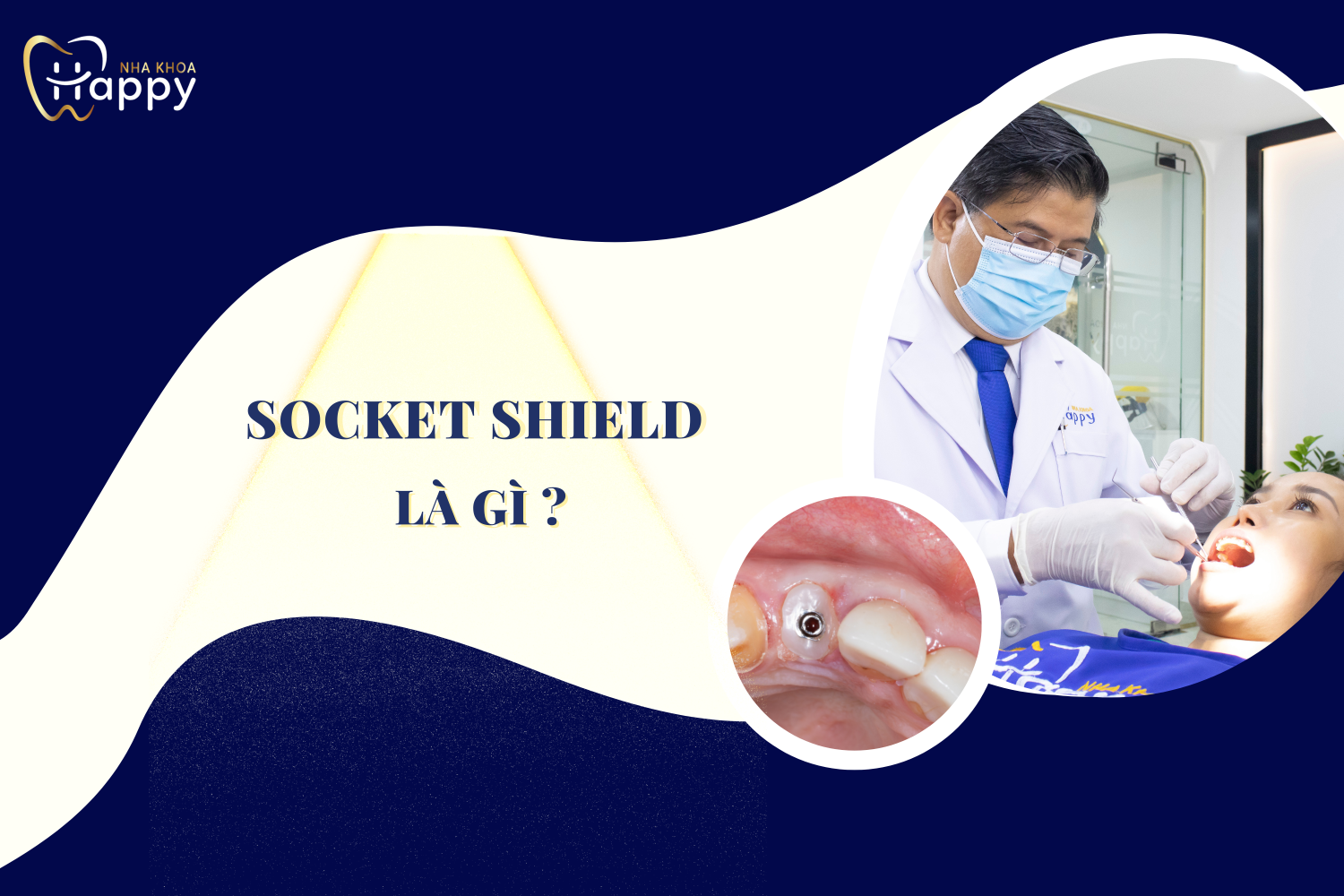 Socket Shield là gì ? Kỹ thuật mới nhất của cấy ghép Implant