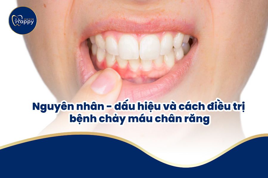 Nguyên nhân - dấu hiệu và cách điều trị bệnh chảy máu chân răng