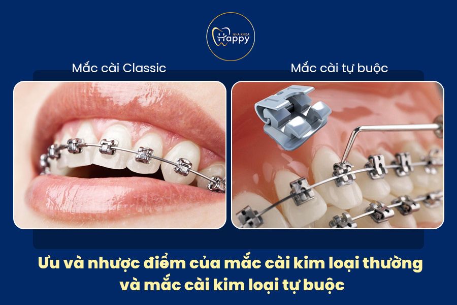 Ưu và nhược điểm của mắc cài kim loại thường và mắc cài kim loại tự buộc