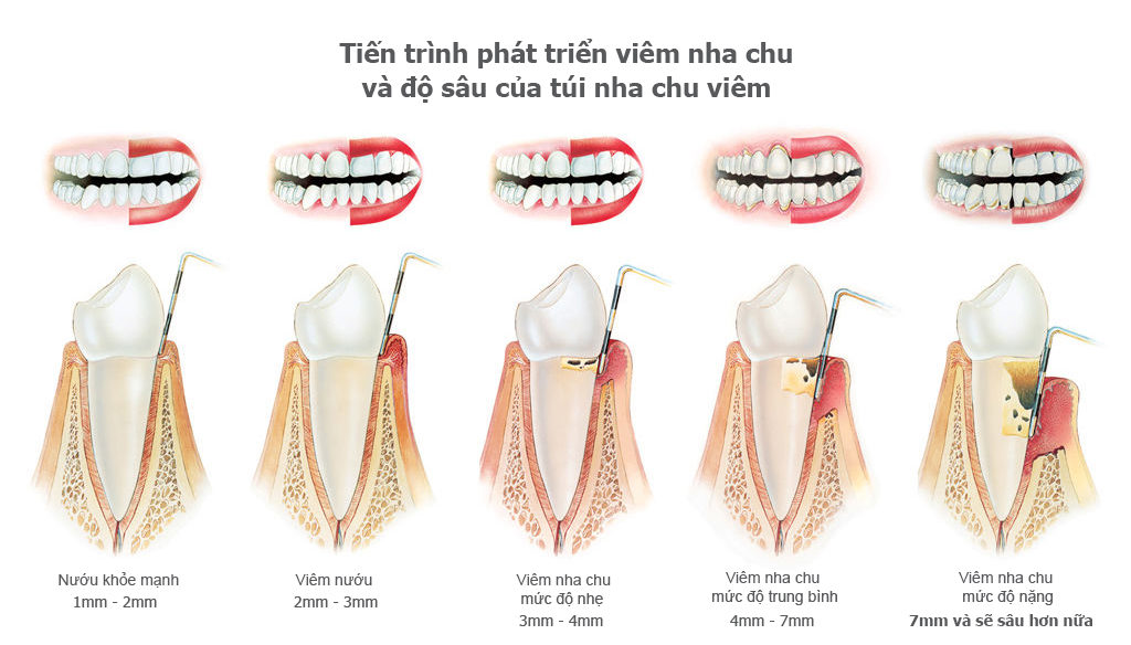 Viêm nha chu là bệnh nguy hiểm về răng miệng, có thể ảnh hưởng toàn bộ cấu trúc răng tác động nghiêm trọng đến sức khỏe răng miệng của người bệnh.