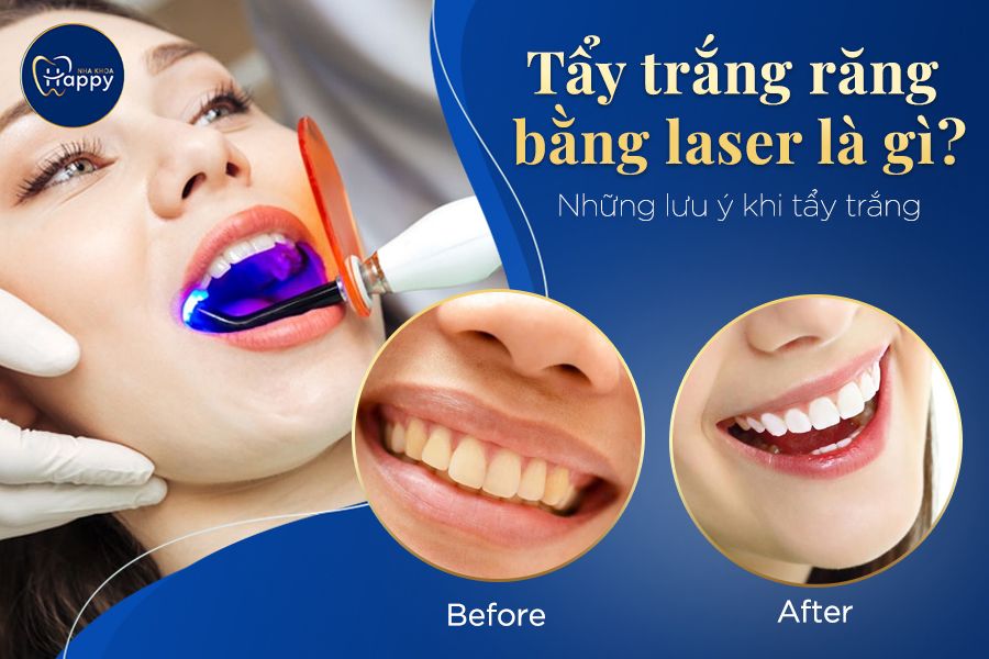 Tẩy trắng răng bằng laser là gì? Những lưu ý khi tẩy trắng