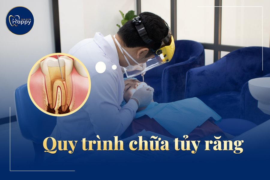 Quy trình chữa tuỷ răng và lưu ý sau khi chữa tuỷ răng