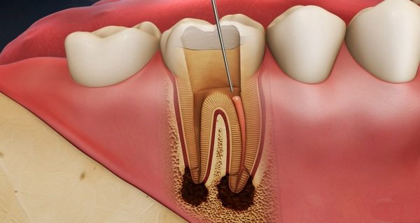 Quy trình chữa tuỷ răng và lưu ý sau khi chữa tuỷ răng