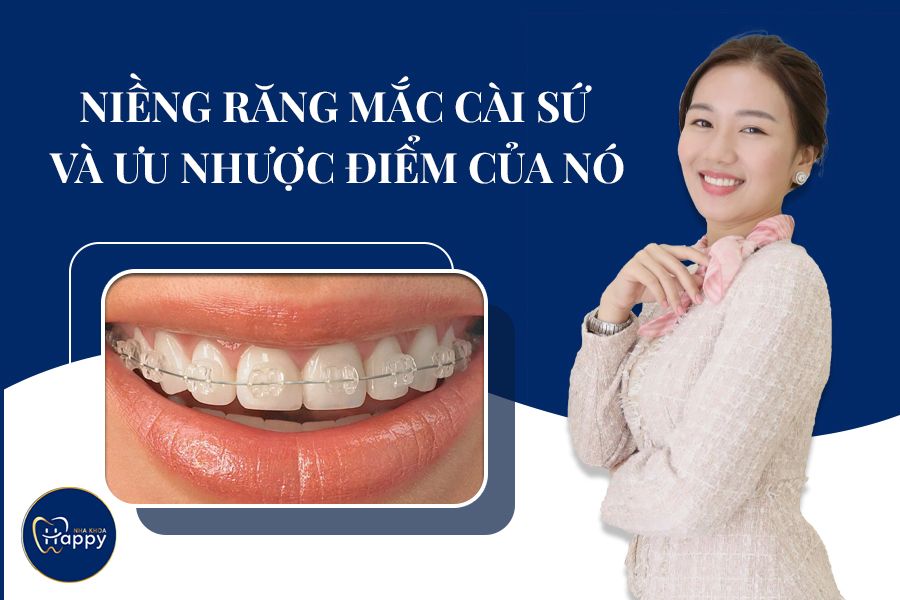 Niềng răng mắc cài sứ và ưu nhược điểm của nó