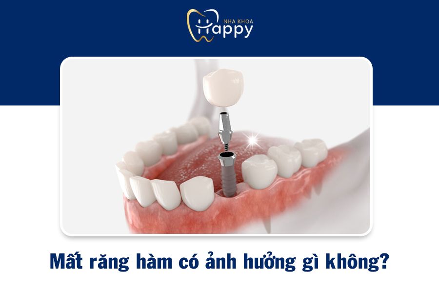 Mất răng hàm có ảnh hưởng gì không? Biện pháp khắc phục