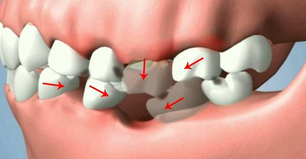 Mất răng hàm có ảnh hưởng gì không? Biện pháp khắc phục