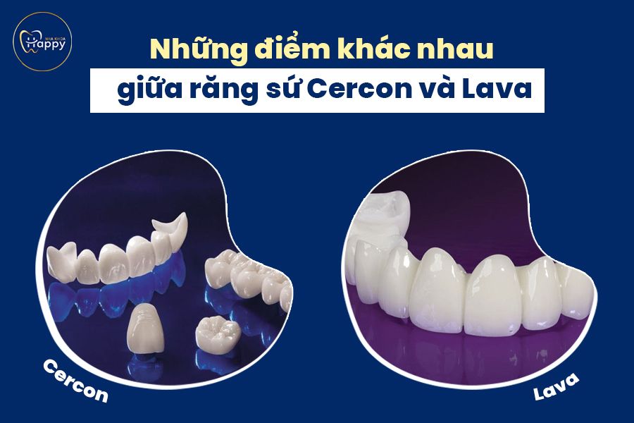 Những điểm khác nhau giữa răng sứ Cercon và Lava