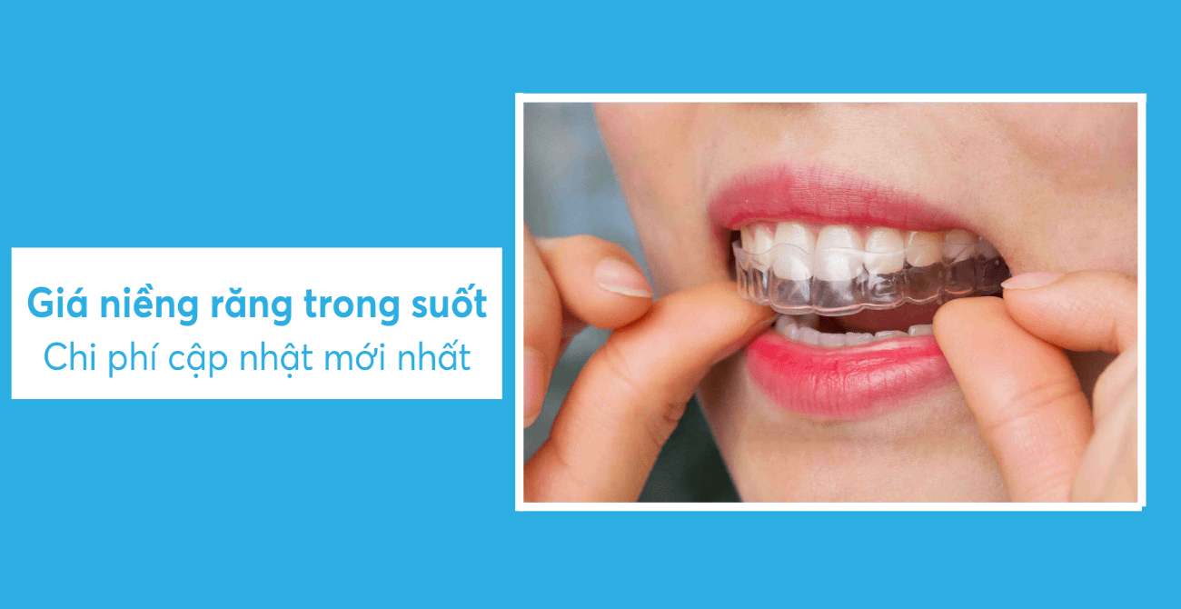 Giá niềng răng trong suốt