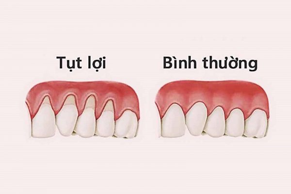 Tụt lợi nha khoa quận bình thạnh