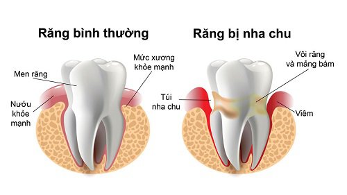 Viêm nha chu nha khoa quận bình thạnh