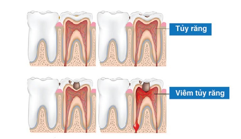 Viêm tủy răng nha khoa quận bình thạnh