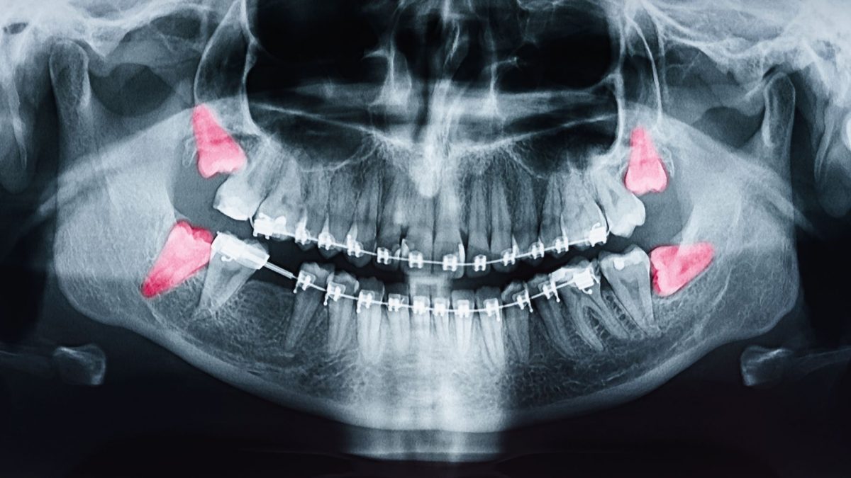 wisdomTeethXRay