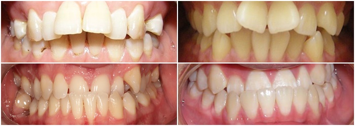 niềng răng trong suốt là gì?