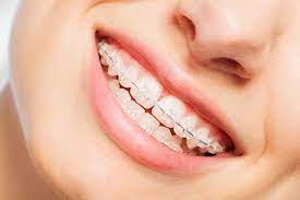 Lợi ích của khay niềng răng trong suốt Invisalign 