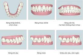 giá niềng răng trong suốt 