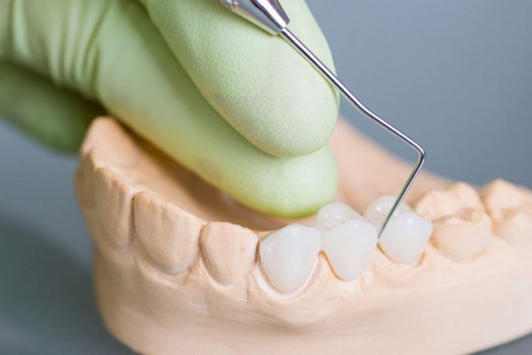 dental bridge picture