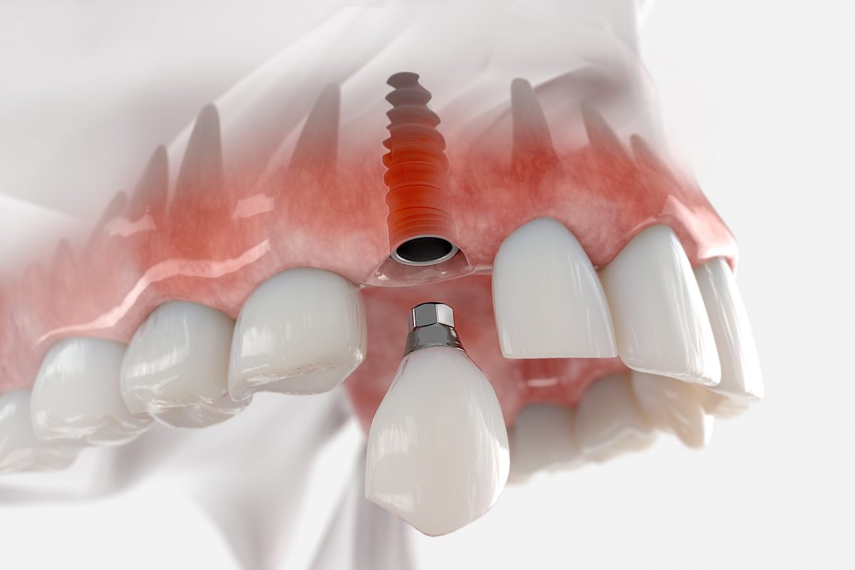 dental implant 1816165793