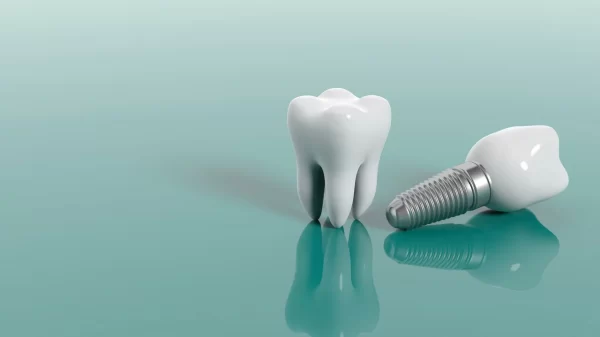 Có nên trồng răng implant hay không