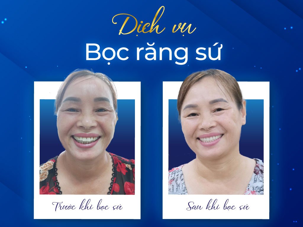 Hình ảnh Khách Hàng khi bọc răng sứ tại Nha Khoa Happy