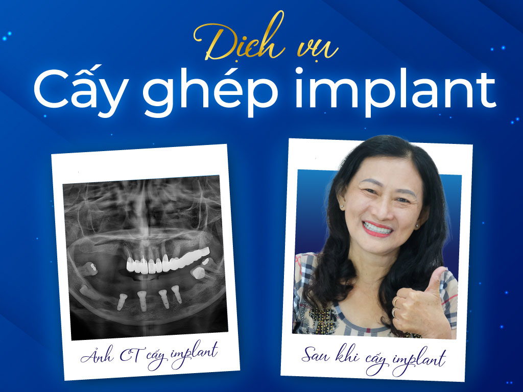 Hình ảnh trước và sau khi trồng răng Implant tại Nha Khoa Happy